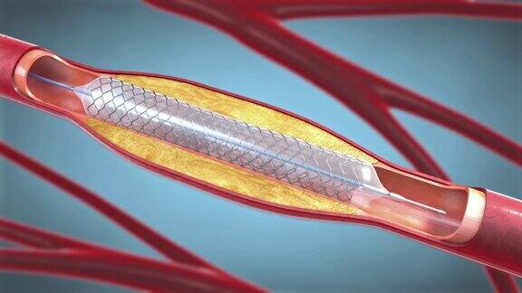 血管成形术中支持血管内血液循环的支架植入3d插图