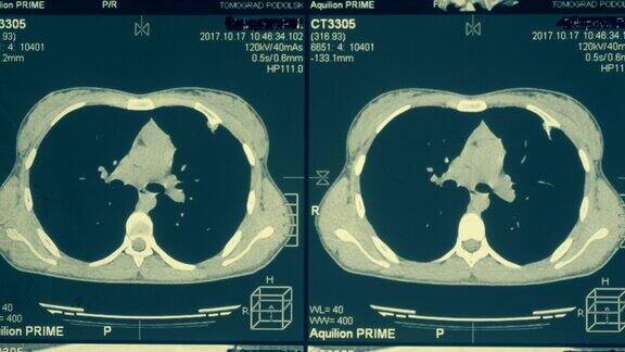 胸部和肺部的磁共振成像(MRI)