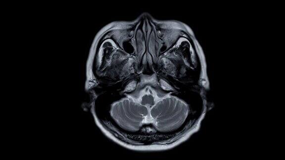 MRI脑或核磁共振成像(MRI)的脑轴t2诊断中风疾病