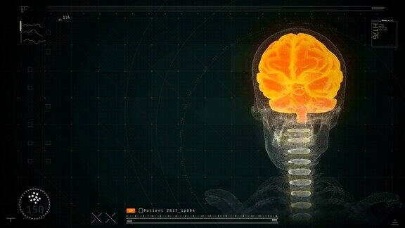 屏幕上显示病人的脑部扫描结果监测活动疾病预测