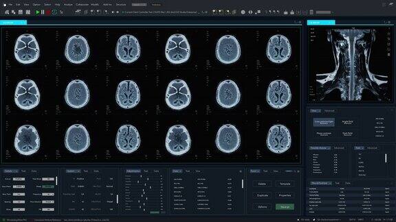 磁共振成像脑扫描模型与多窗口和数据专业医学研究软件模板与MRI结果的计算机显示器和笔记本电脑屏幕