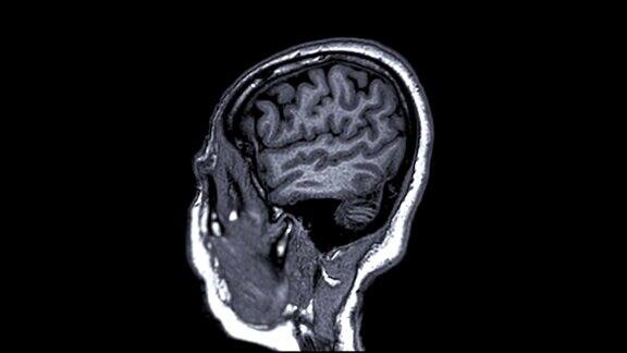 MRI脑矢状T1W可以帮助医生寻找诸如出血、肿胀、肿瘤、感染、炎症、损伤或中风疾病等情况