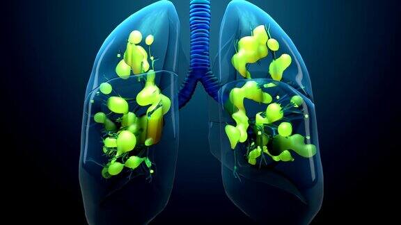 肺部损害、严重呼吸系统疾病、肺炎、急性呼吸窘迫综合征(ARDS)、冠状病毒引起的急性呼吸窘迫综合征