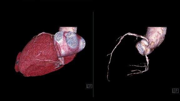 CTA冠状动脉三维渲染图像比较心脏三维和冠状动脉三维在屏幕上旋转诊断血管冠状动脉狭窄