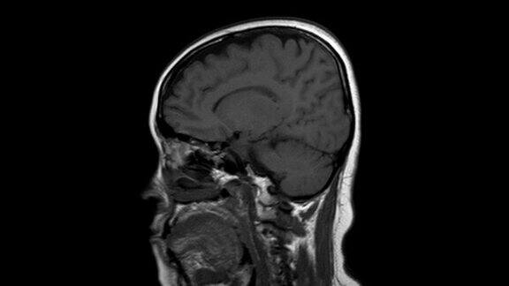 脑磁共振成像(MRI)脑瘤