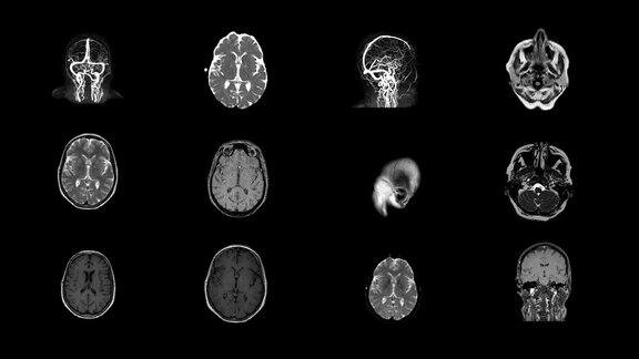 人脑MRI扫描