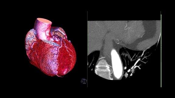 冠状动脉三维绘制