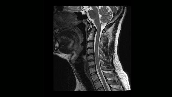 计算机医学断层扫描MRI扫描颈椎与骨软骨病的男性