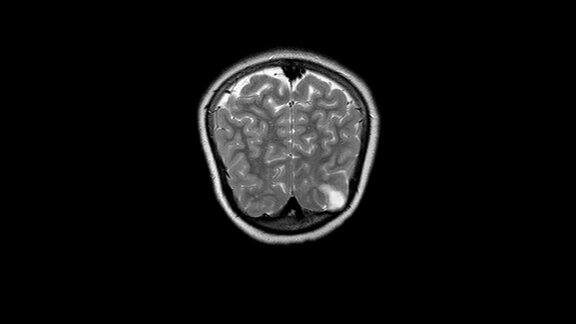 脑MRI:右侧顶叶脑瘤