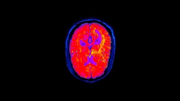 磁共振成像是MRI扫描人类大脑功能障碍、出现问题的区域时间流逝x射线计算机医学体层摄影RGB红外摄像机