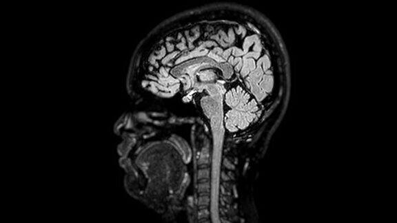 大脑MRI