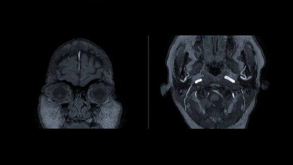 脑磁共振或磁共振血管造影显示脑动脉轴位和冠状位MIP