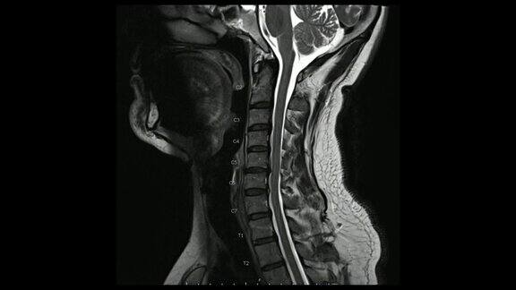 电影模式下颈椎矢状t2加权图像的磁共振成像(MRI颈椎)