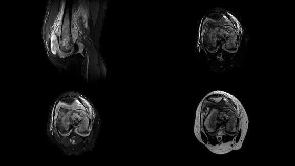 右膝MRI病史:15岁女性右股骨病理性骨折
