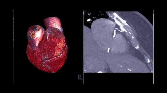 冠状动脉三维绘制