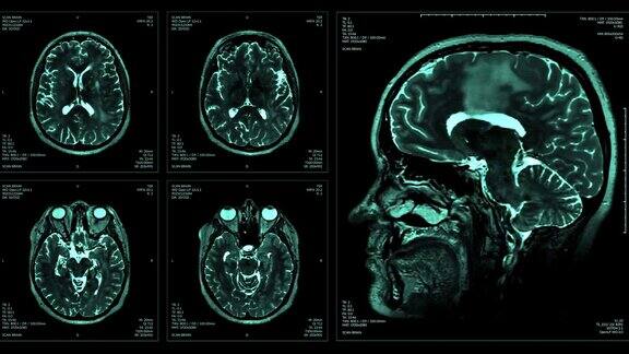 脑部MRT扫描显示
