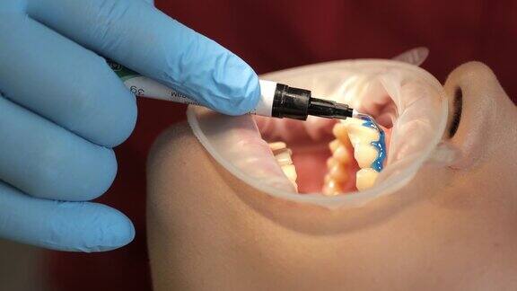在牙科诊所进行牙齿美白手术的病人医疗保健和医药概念