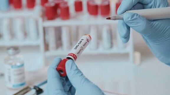 医生手持SARS-CoV-3血液检测阳性的试管的特写