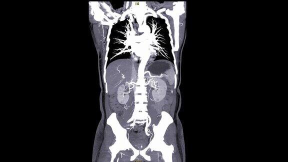 CTA腹主动脉冠状动脉MIP视图慢镜头4k