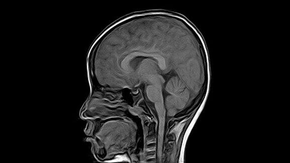 脑MRI:8岁男孩病史:头痛3天发现大面积急性脑实质出血以白质为中心轻度累及皮质