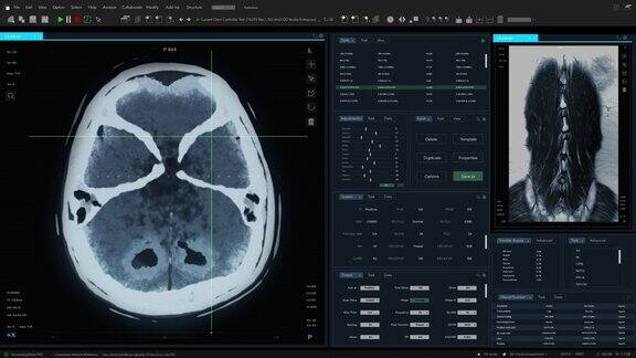 磁共振成像大脑和脊髓扫描模型与多窗口和数据专业医学研究软件模板与MRI结果的计算机显示器和笔记本电脑屏幕