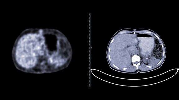 正电子发射断层扫描或PETCT扫描整个人体寻找复发肿瘤比较PETCT和CT扫描轴位视图