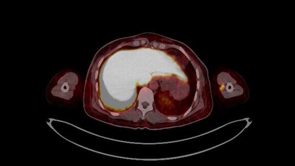PETCT扫描(正电子发射断层扫描)全身三维渲染图像红色色调轴向视图用于检测术后肿瘤复发