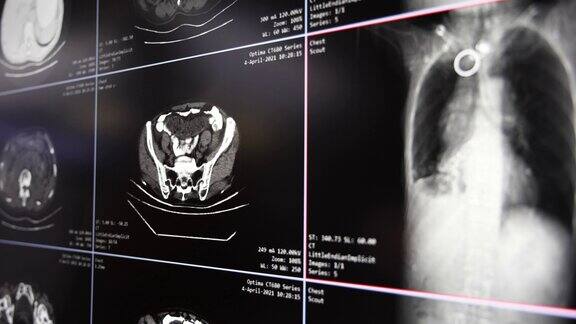 MRI腹腔断层扫描