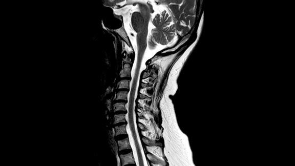 颈椎T2W矢状位MRI诊断C3、C4处脊髓受压