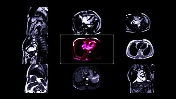 心脏MRI(心脏磁共振成像)