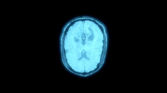 磁共振成像人脑的核磁共振扫描超高清4k延时x射线计算机医学体层摄影医疗蓝色