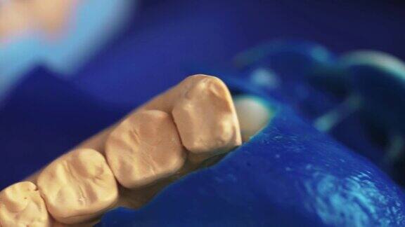 牙科中的雕刻塑料假牙牙科假肢3D扫描颌骨
