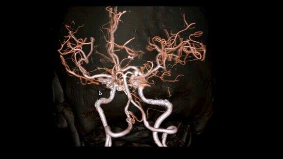 脑部CTA或脑部ct血管造影(computedtomographyangiographyoftheBrain)三维显示脑部动脉和透明骨在屏幕上旋转的图像