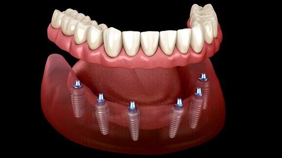 下颌假体全部在6个系统上由种植体支持医学上精确的人类牙齿和假牙的三维动画概念