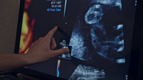 超声波监视器屏幕显示婴儿在母亲的子宫