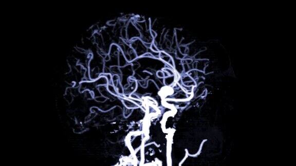 脑部CTA或脑部ct血管造影显示前交通动脉或ACOM动脉瘤的3D渲染图像