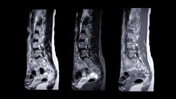 脊柱MRI条件下