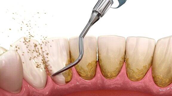 口腔卫生:超声波洁牙(常规牙周治疗)医学上精确的人类牙齿治疗3D动画