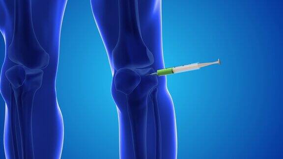 向人类膝盖注射干细胞