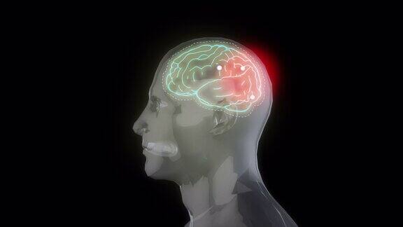头痛人的三维动画3D渲染隔离在黑色背景上医学概念