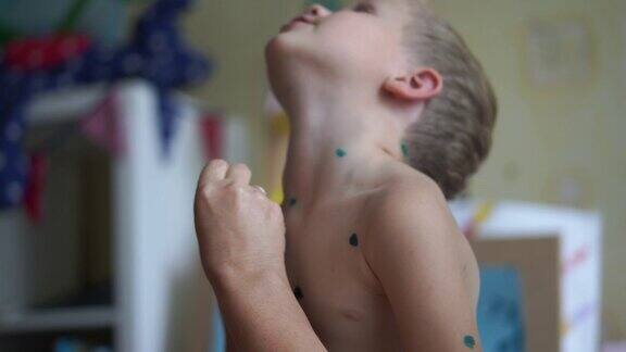 水痘在小男孩-一个妇女在家里治疗一个孩子水痘-手持式注射