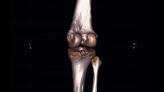 膝关节CT扫描三维绘制