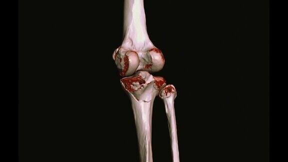 膝关节CT扫描三维绘制
