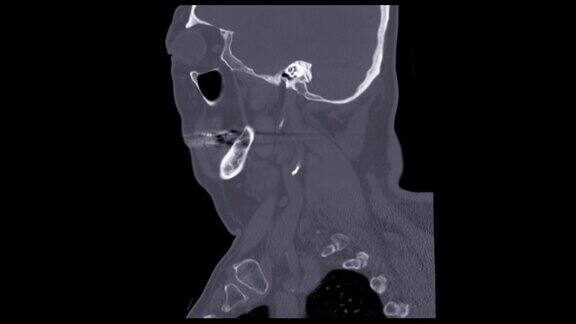 CT颈椎或颈椎矢状面