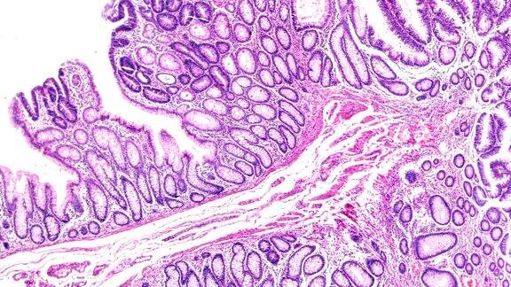 肠腺瘤病人体病理标本的显微镜观察