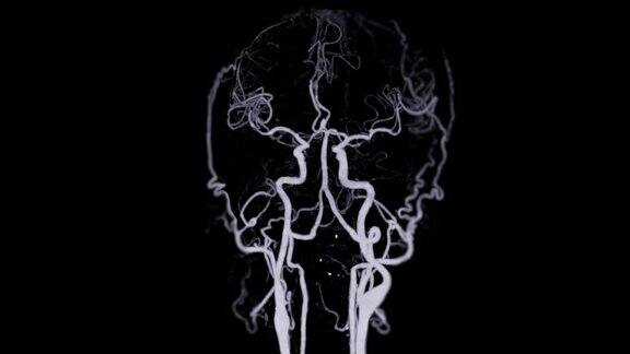 CTA脑部扫描或计算机断层血管造影3D渲染