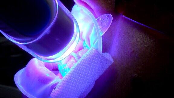紫外线美白牙齿-一台紫外线美白机的特写操作病人的牙齿在4k拍摄