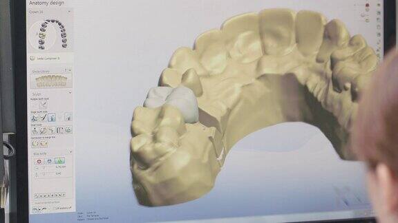 牙科实验室技术员在三维建模软件中设计种植体
