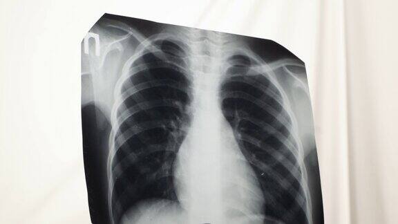 不明男性医生在医院放射科检查患者胸部x光片肺部扫描的特写站在光板旁