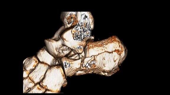 CAT扫描图像足部三维渲染